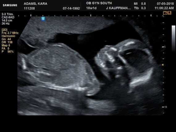baby ultrasound image